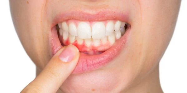 Gum-disease_ Gum-disease_