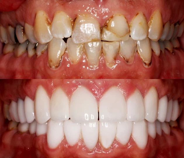 Full Mouth Rehabilitation Full Mouth Rehabilitation