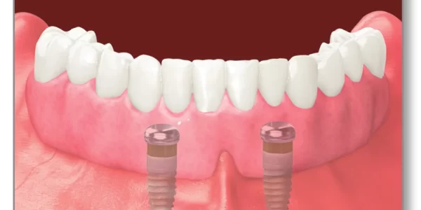 Implant-Supported-Denture-2 Implant-Supported-Denture-2