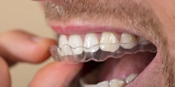 Occlusal Night Guard Close Up