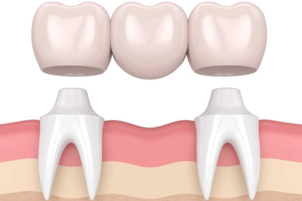 dental-bridge-vector