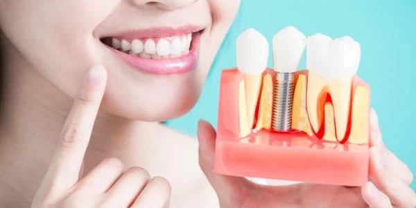 Implant Dentistry Implant Dentistry