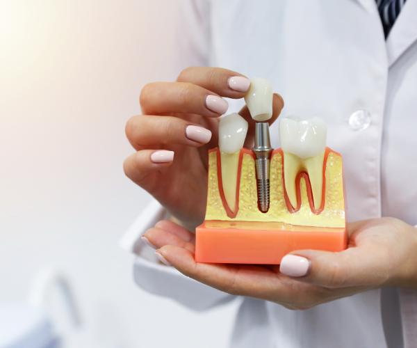 Guided Implant Placement Guided Implant Placement