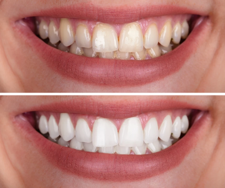 Teeth Whitening Teeth Whitening