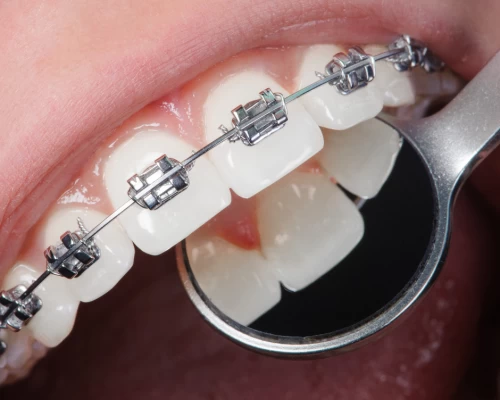 Invisalign