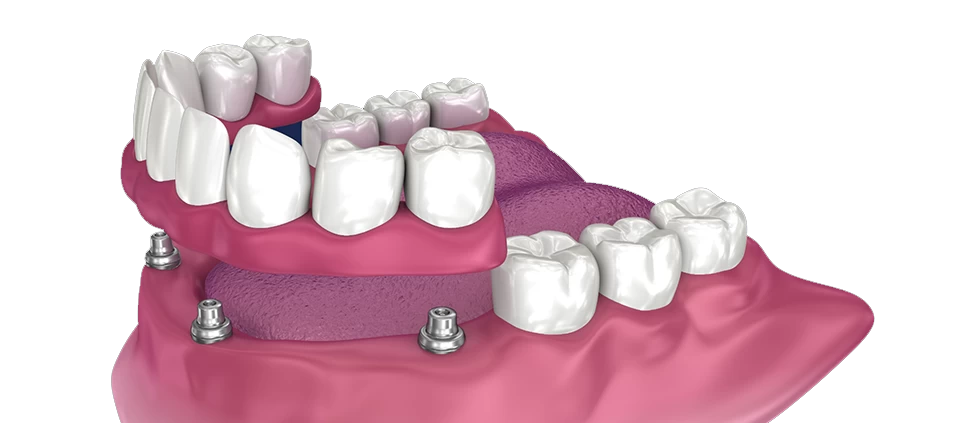What-are-All-on-4-Dental-Implants copy Dental Imlpant Benefits