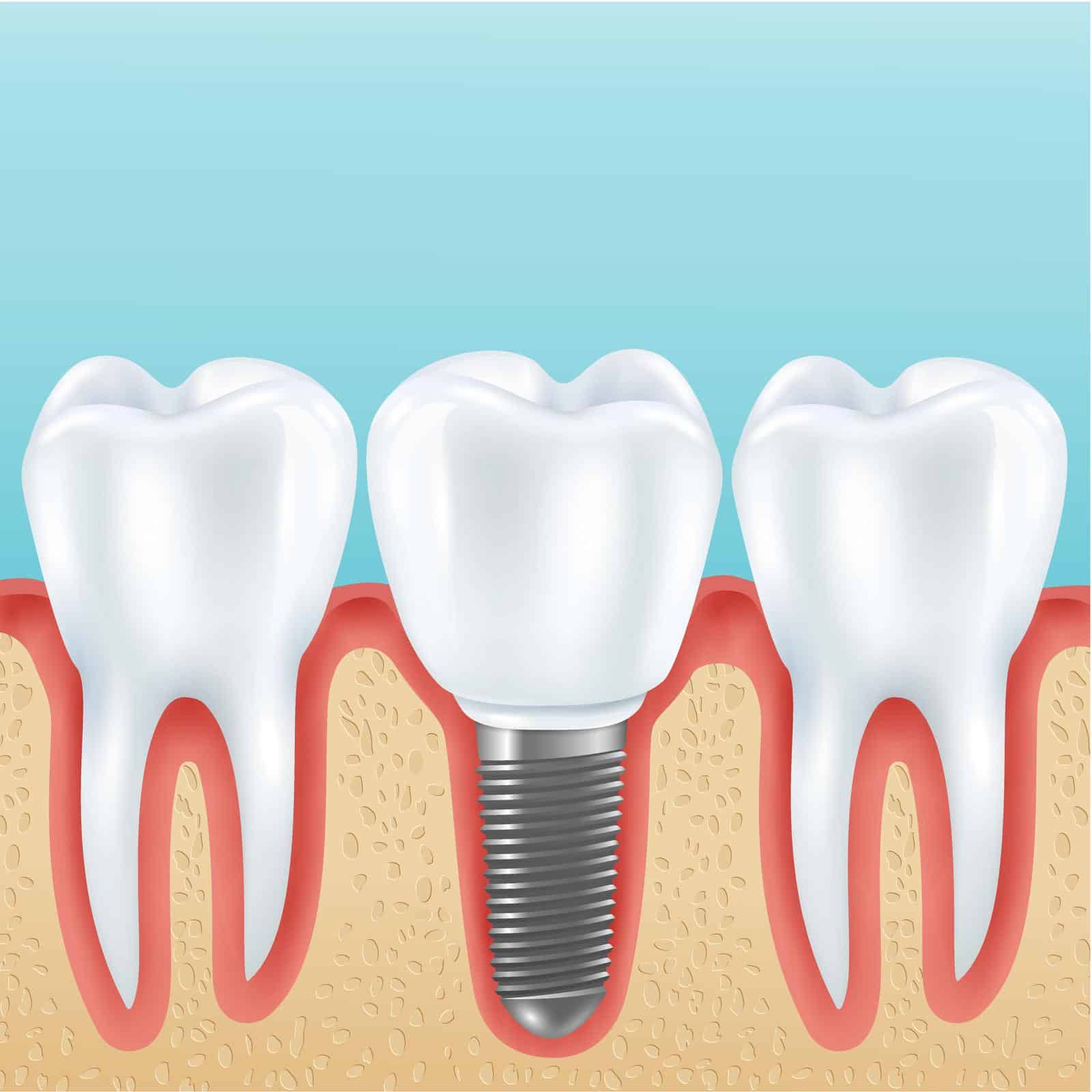 surgical 5 Replacing Teeth