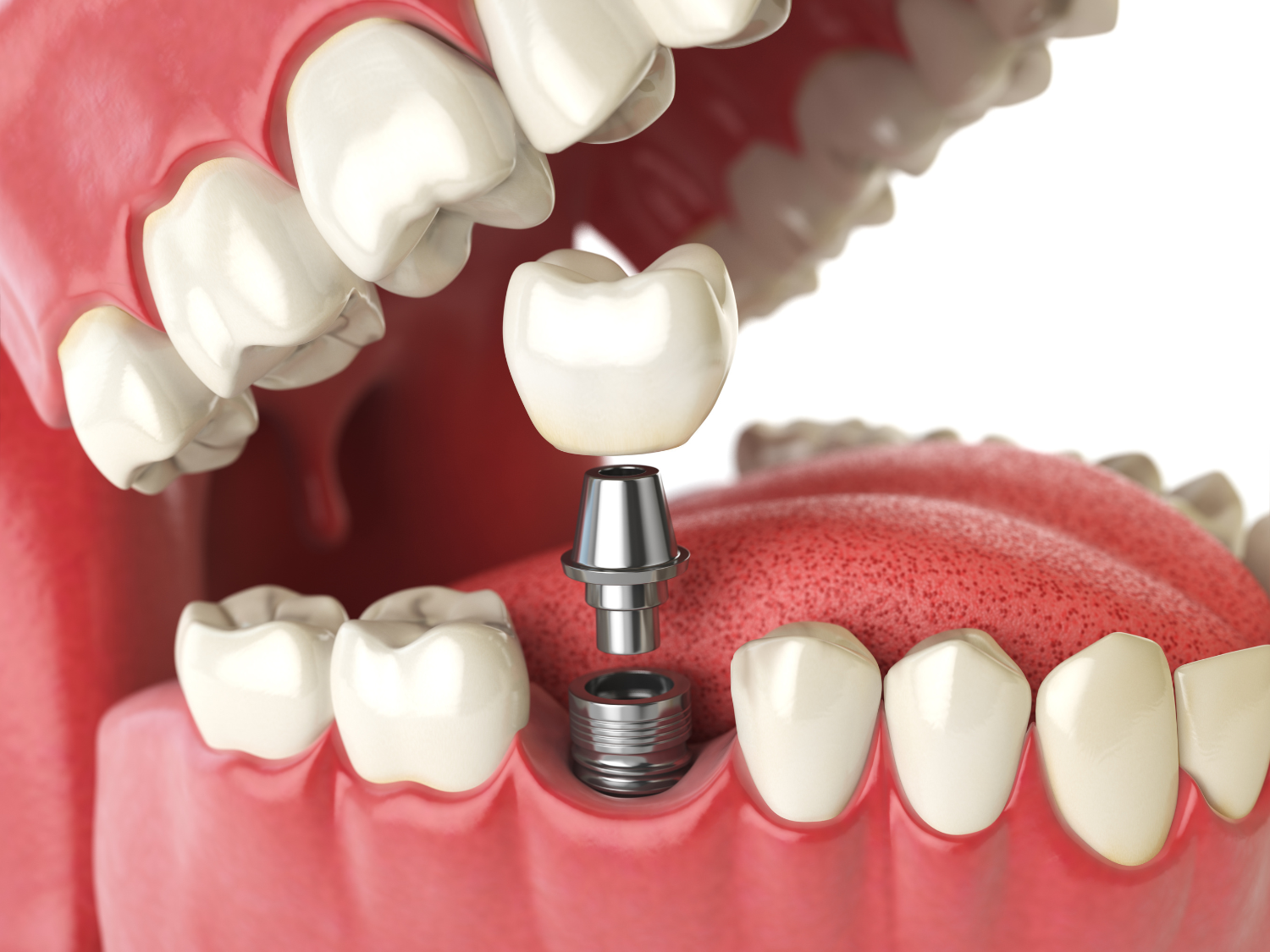 implant1 implant1